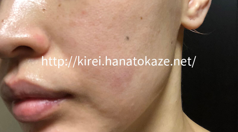 ゼオスキン４週目のニキビ肌
